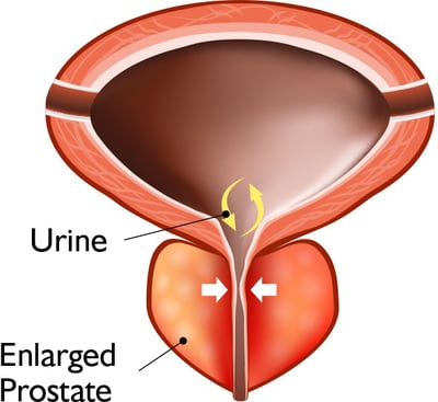 Diagram of a prostate with BPH Diagram of a prostate with BPH