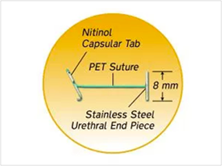 UroLift implant diagram UroLift implant diagram