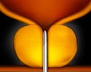 Step 1 of the UroLift system