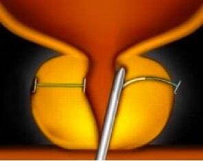 Step 2 of the UroLift system